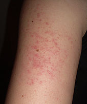 Small, red, monomorphic skin lesions on the back of an adult arm