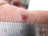 A solitary papule of inflamed vascular granulation tissue on the index finger of an adult