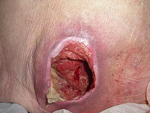A large ulceration of the lower back with complete loss of the overlying skin