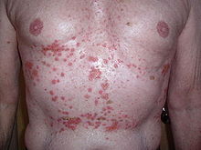 Adult chest and abdomen with many red skin lesions