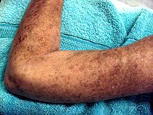 Multiple, brownish colored patches of skin on an adult arm