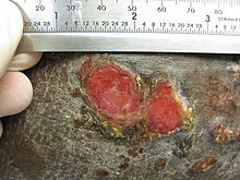 A large ulcerated plaque on the leg of an adult male
