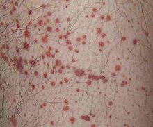 Red, non-blanching skin lesions on the upper leg