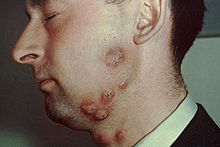 Multiple circular, red, scaling lesions on a male cheek