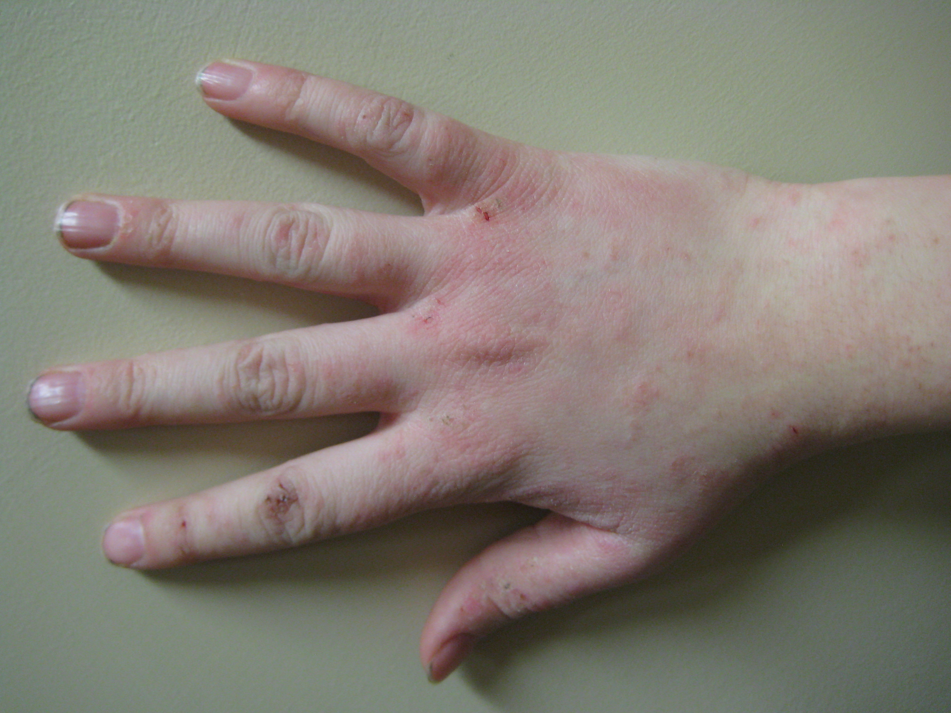Hand dermatitis | DermNet New Zealand