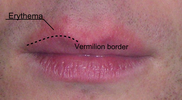 What Causes Cracked Lips On The Side