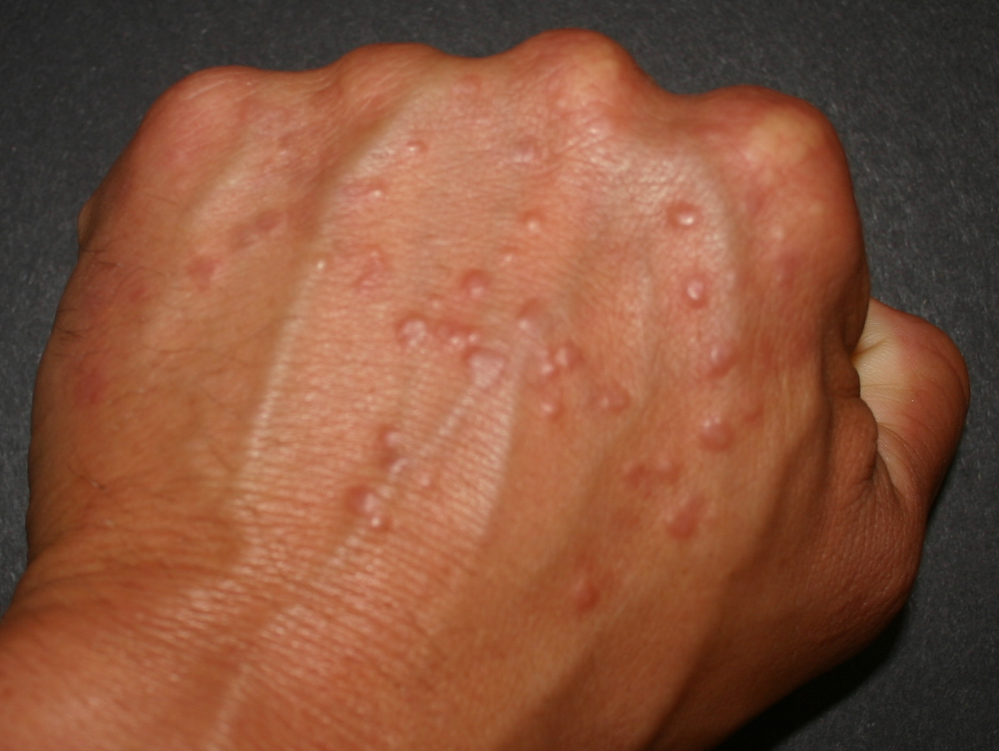 causes of hives in adults #10