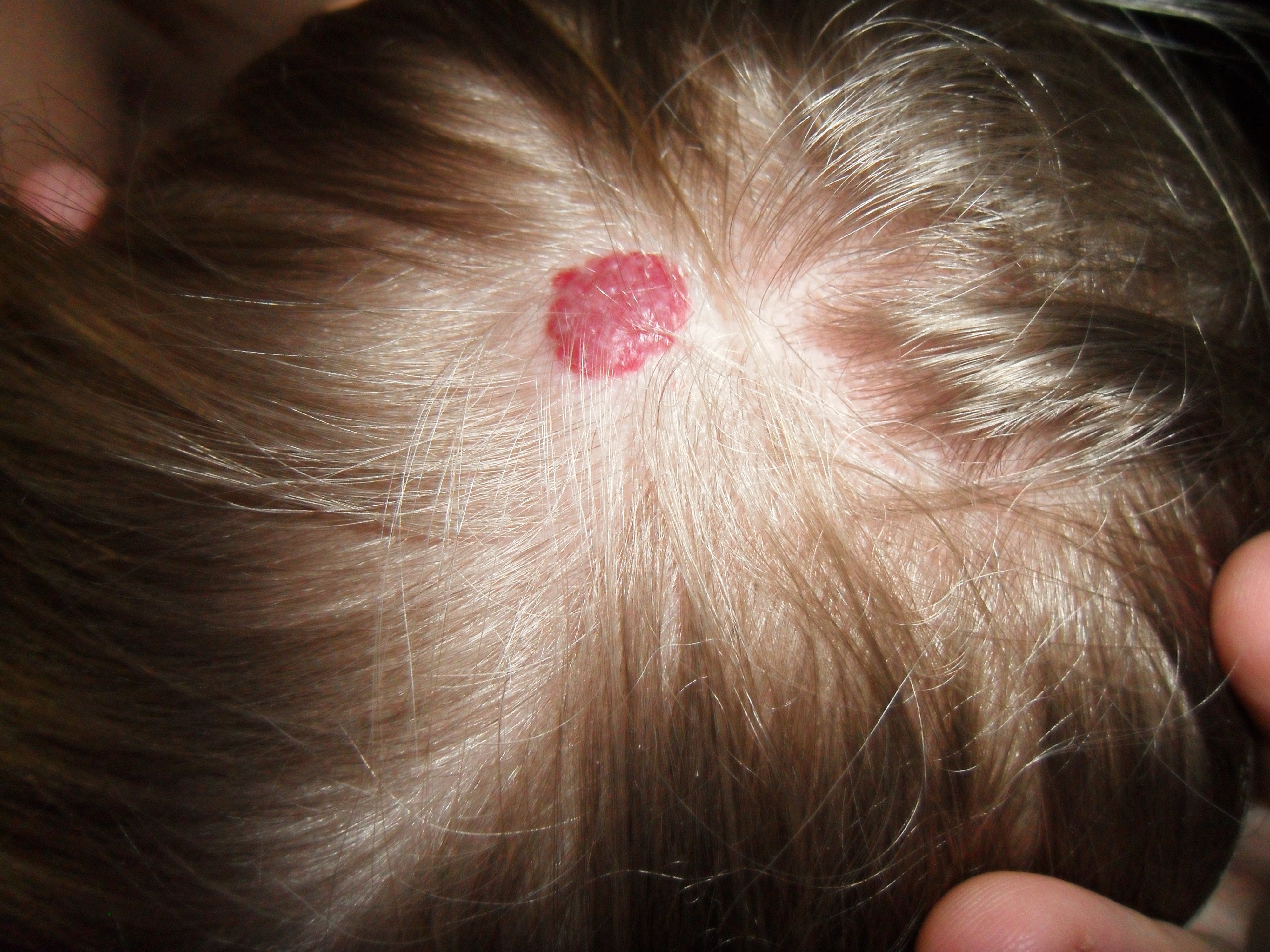 MIF Forums • Pink/reddish mole on scalp? - NeonCRM
