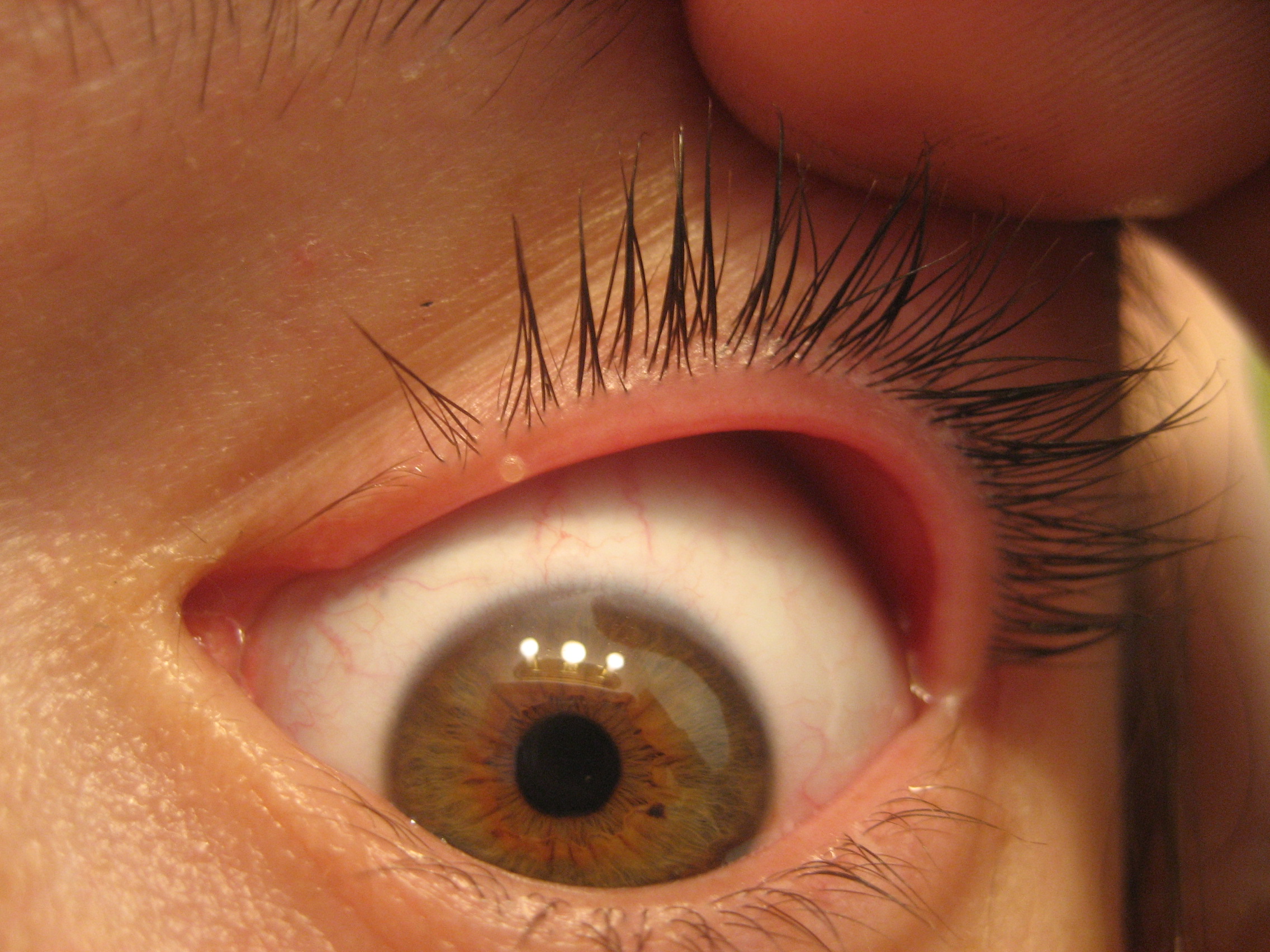 Blepharitis/Eyelid Inflammation Directory: Find News ...