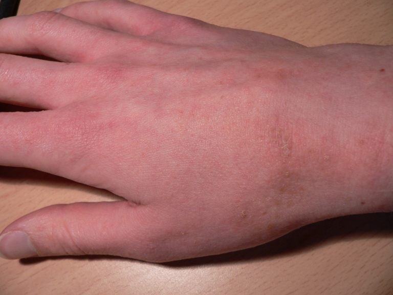 Pictures of Scabies Burrows | Pictures of Scabies