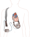 Ventricular assist device.png