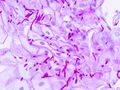 Esophageal candidiasis (2) PAS stain.jpg