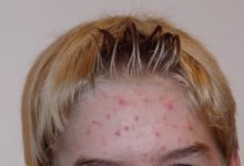 Adult forehead with scattered red pimples