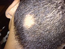 Circular coin-sized bare patch on the back of a person's scalp