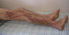 Many hyperkeratotic, vegetative, and hyperpigmented papules in a zosteriform pattern on the right lateral lower extremity of an adult