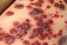 Multiple dark red skin lesions