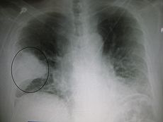 A Xray showing a white wedge in the right lung field of a chest X-ray.
