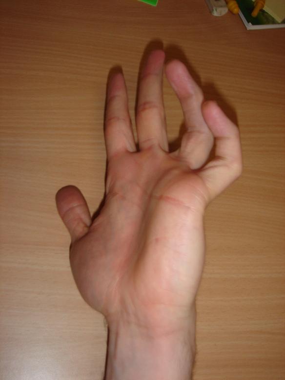 Руками портит. Порванное сухожилие на пальце. Сухожилия мезинец на руке. Порвать сухожилие на руке большого пальца.